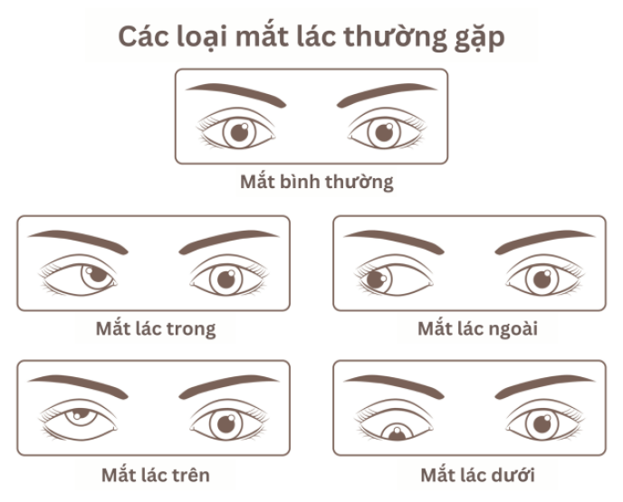 lac-mat---nguyen-nhan-va-trieu-chung-nhan-biet