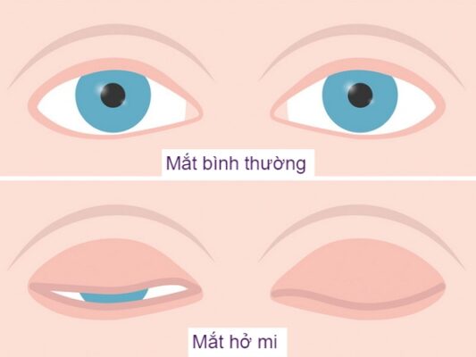 nguyen-nhan-va-cach-dieu-tri-ho-mi-mat