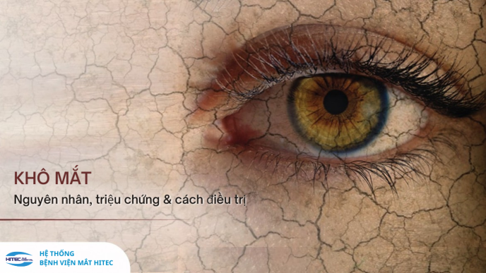 kho-mat-la-gi-nguyen-nhan-trieu-chung-va-cach-dieu-tri-hie