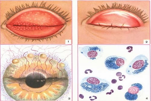 Vi khuẩn Chlamydia Trachomatis là 1 trong các nguyên nhân gây bệnh mắt hột