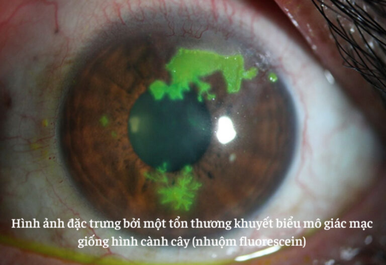 Hình ảnh cành cây trong viêm giác mạc