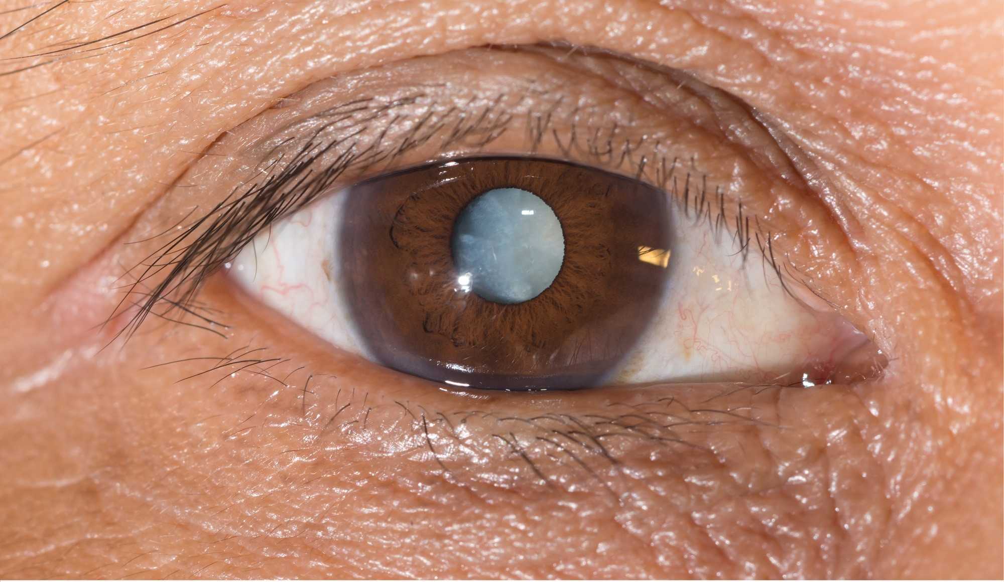Cườm mắt là căn bệnh nhãn khoa rất nguy hiểm