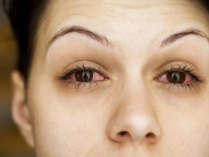 Cách chăm sóc mắt thường xuyên bị đỏ để duy trì sức khỏe