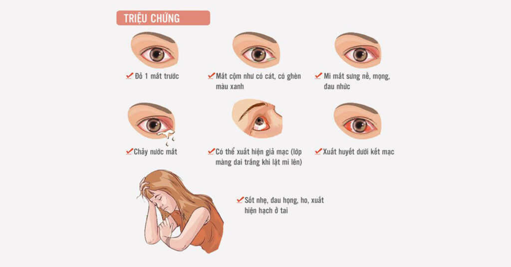 Triệu chứng nhận biết đau mắt đỏ ( viêm kết mạc)